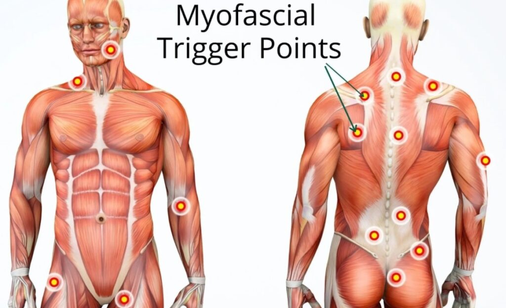 Lacrosse Balls 10 Fig 6 Myofascial trigger points