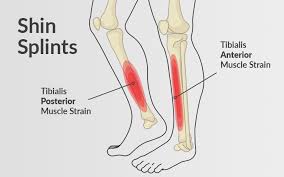 Figure 14 Shin Splints